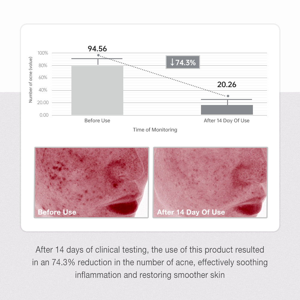 Salicylic Acid Anti Acne Serum