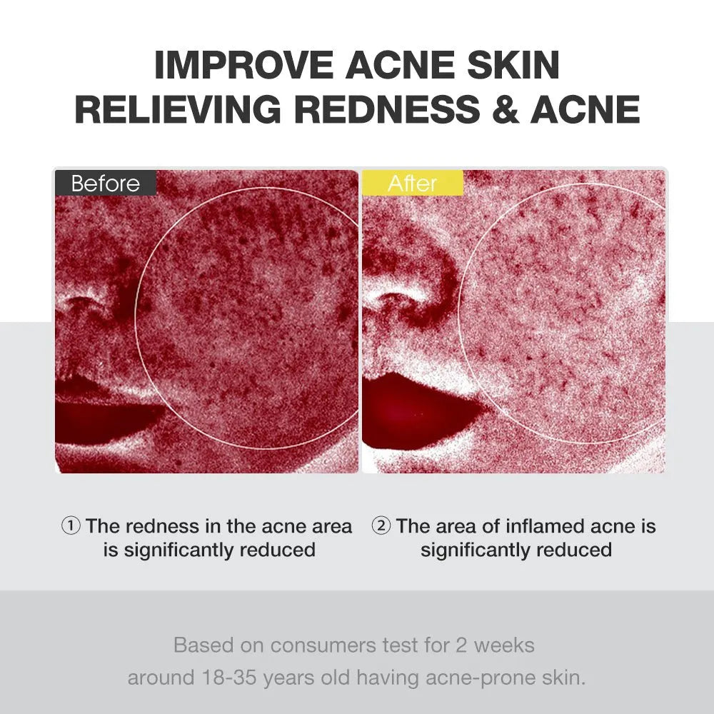 SKINEVER Salicylic Acid Acne Treatment Ice Sleep Masque 55ML